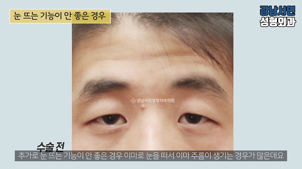 남자 눈성형 수술 전 사진