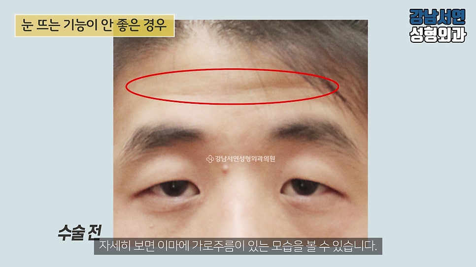 남자 눈성형 수술 전 사진