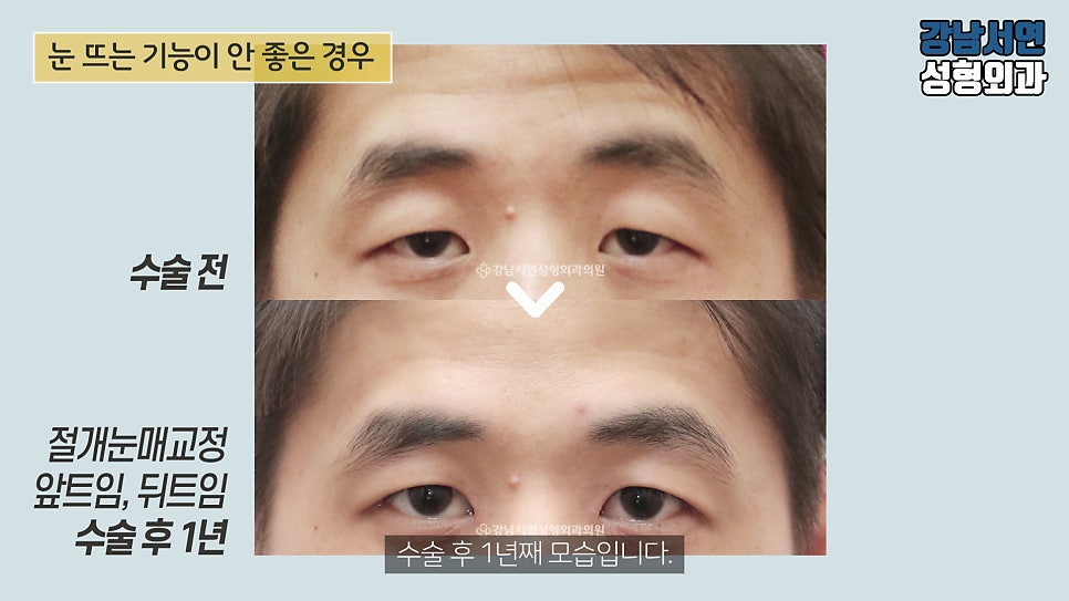 남자 눈성형 수술 전후 비교 사진