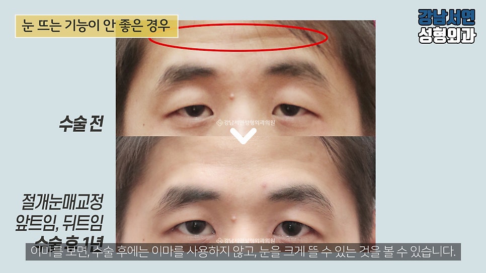 남자 눈성형 수술 전후 비교 사진