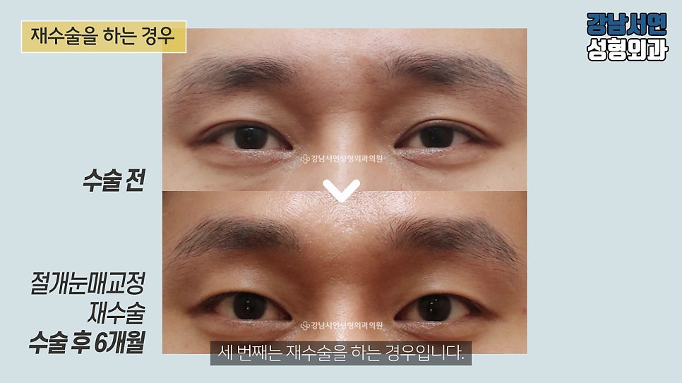 남자 눈성형 수술 전후 비교 사진