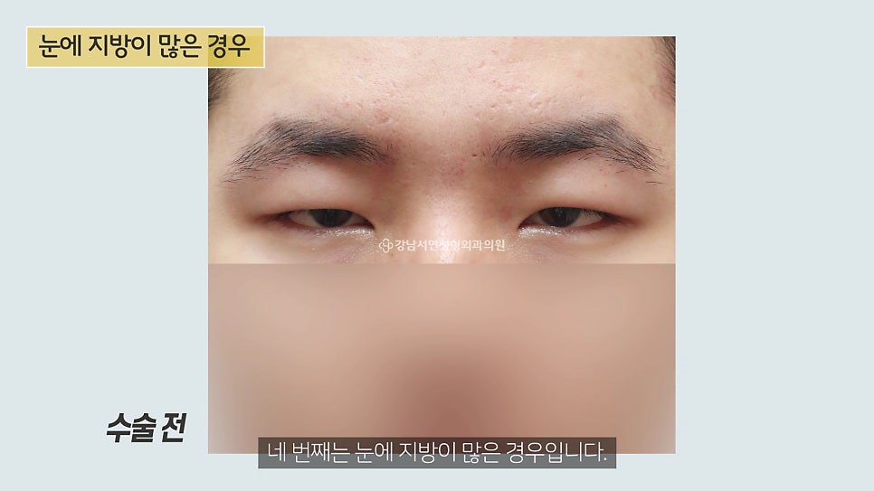 남자 눈성형 수술 전 사진