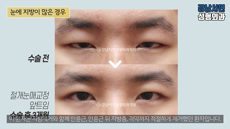 남자 눈성형 수술 전후 비교 사진
