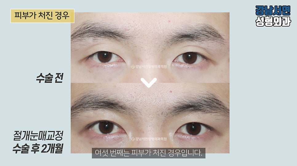 남자 눈성형 수술 전후 비교 사진