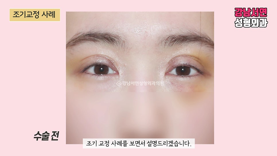 쌍꺼풀 재수술 전 사진