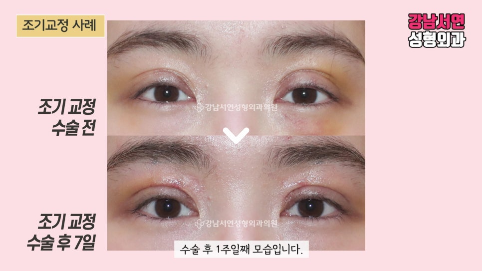 쌍꺼풀 재수술 전후 비교 사진