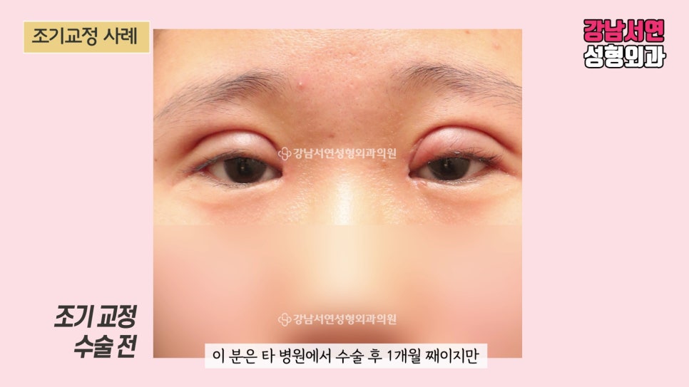 쌍꺼풀 재수술 전 사진