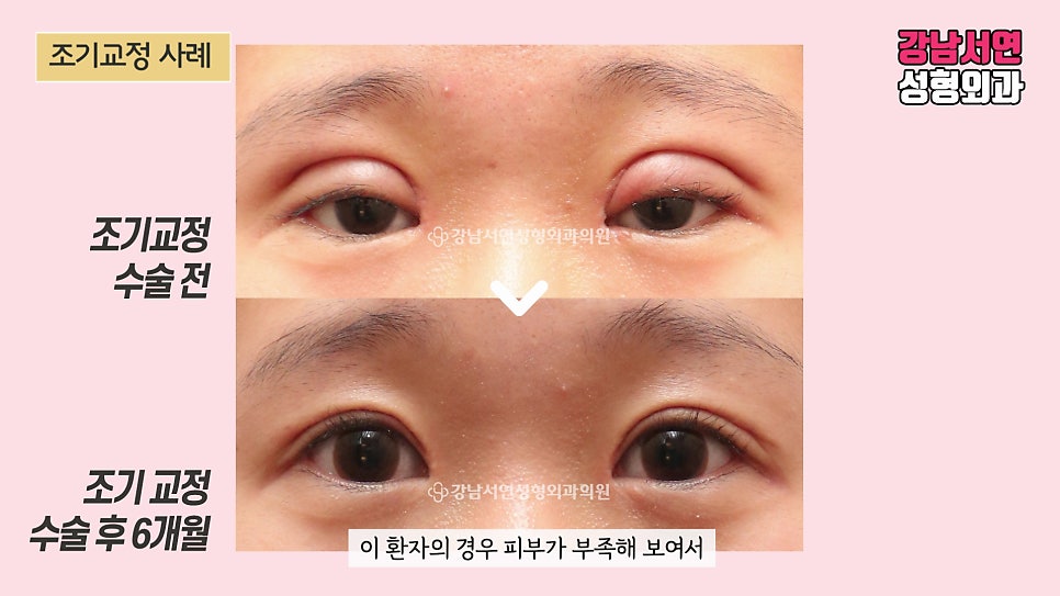 쌍꺼풀 재수술 전후 비교 사진