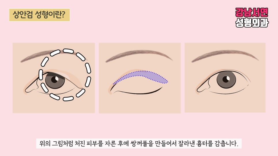상안검성형 설명 도해