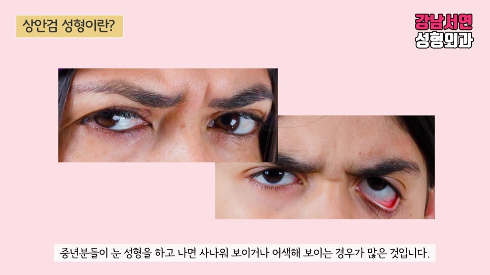 상안검성형 수술 사례 눈 사진