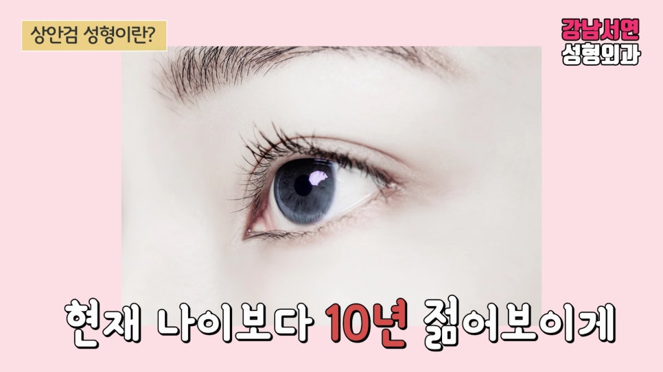 상안검성형 안내 이미지