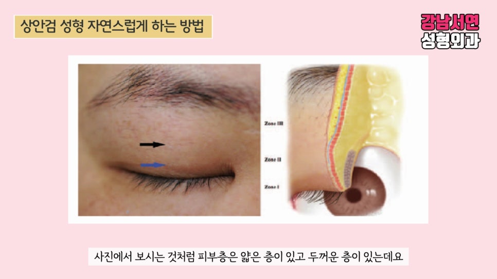 상안검성형 설명 도해