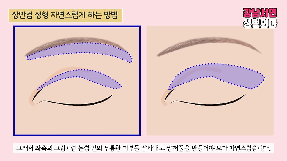 상안검성형 설명 도해