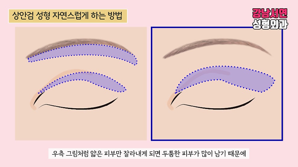 상안검성형 설명 도해