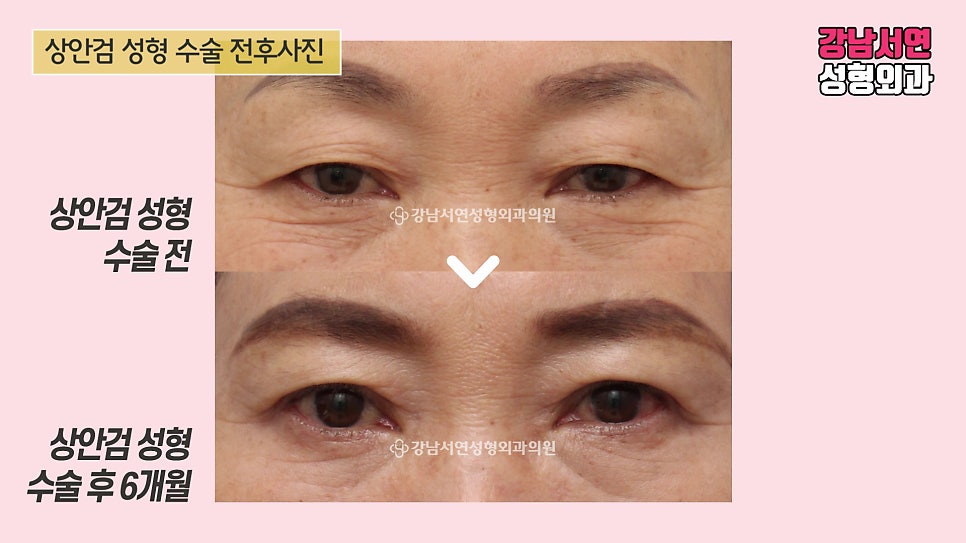 상안검성형 수술 전후 비교 사진