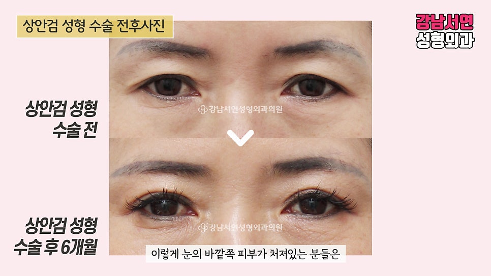 상안검성형 수술 전후 비교 사진