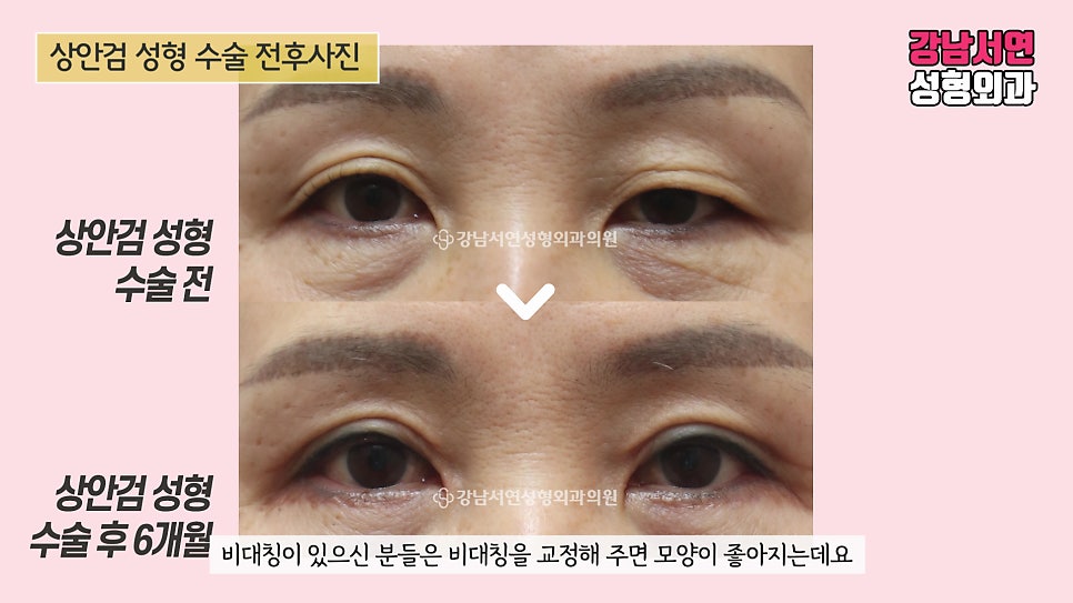 상안검성형 수술 전후 비교 사진