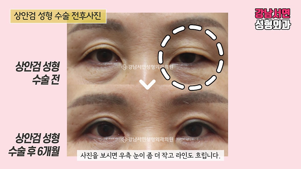상안검성형 수술 전후 비교 사진