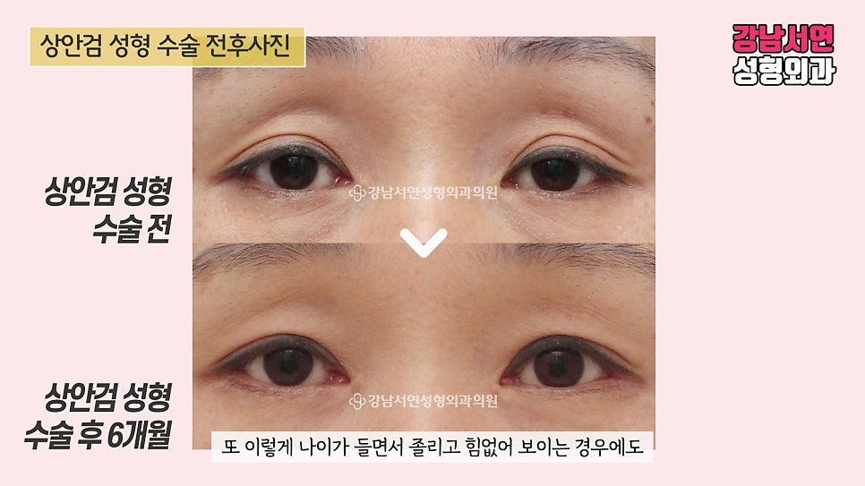 상안검성형 수술 전후 비교 사진