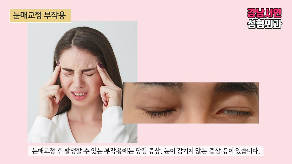 눈매교정 설명 도해