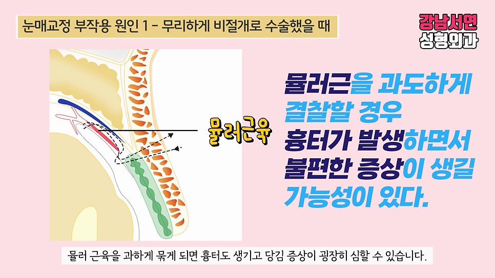 눈매교정 설명 도해
