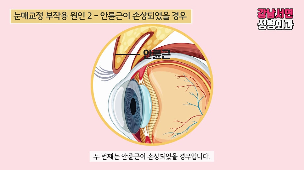눈매교정 설명 도해