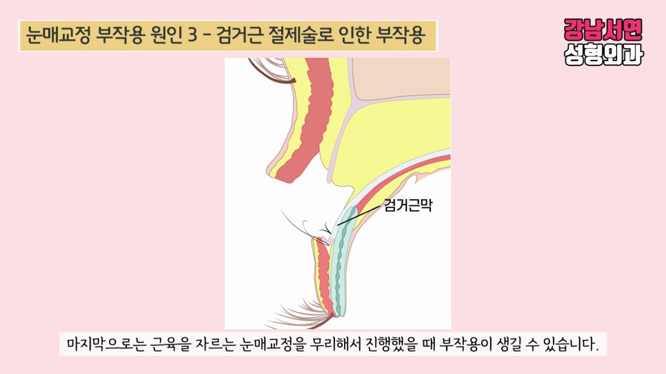 눈매교정 설명 도해