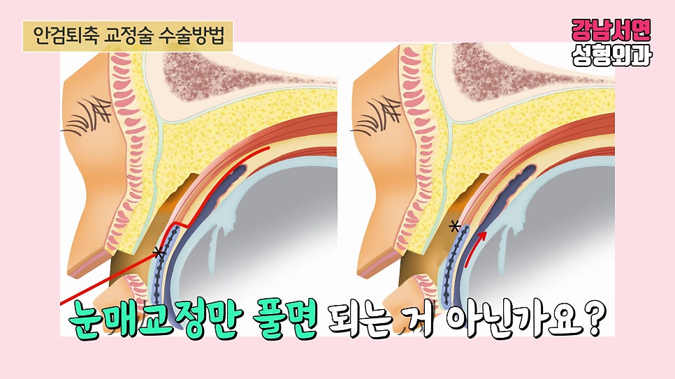 퇴축수술 설명 도해