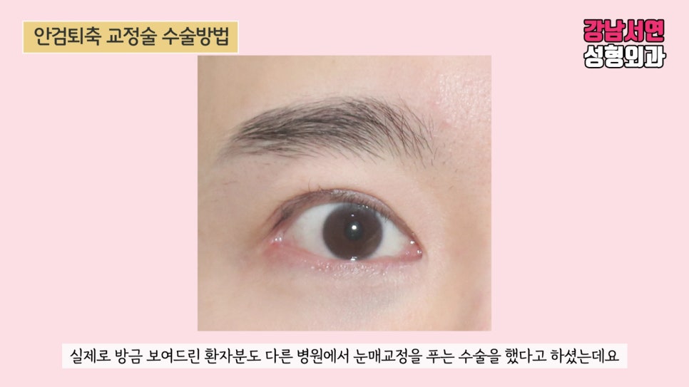 퇴축수술 사례 눈 사진