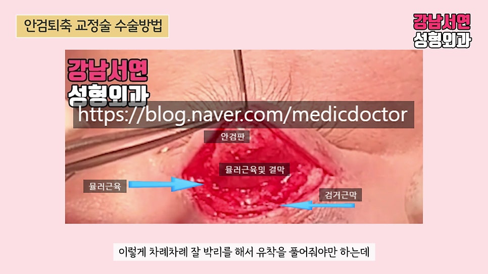 퇴축수술 장면