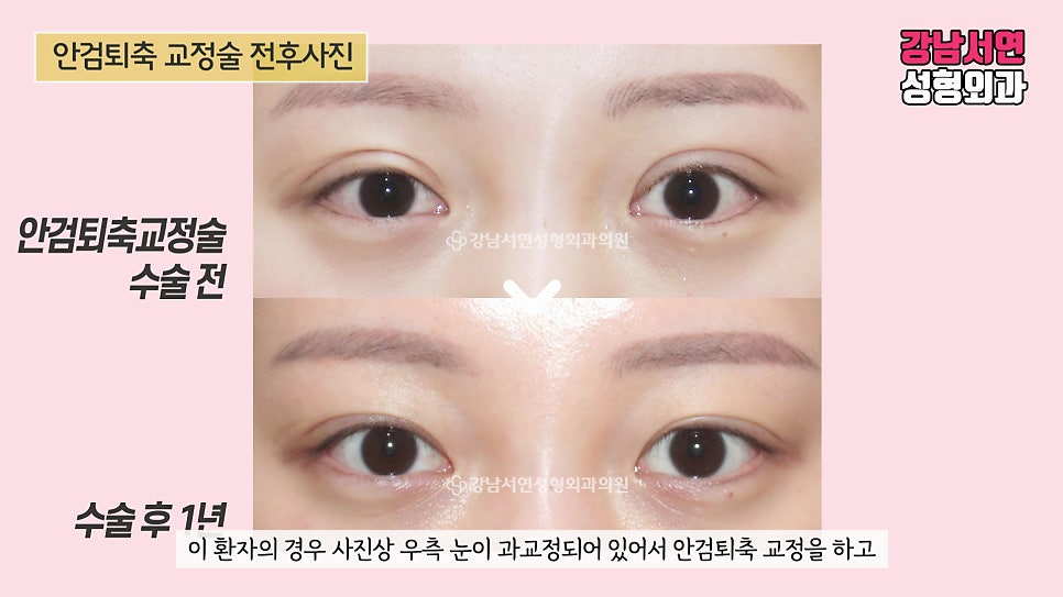 퇴축수술 전후 비교 사진