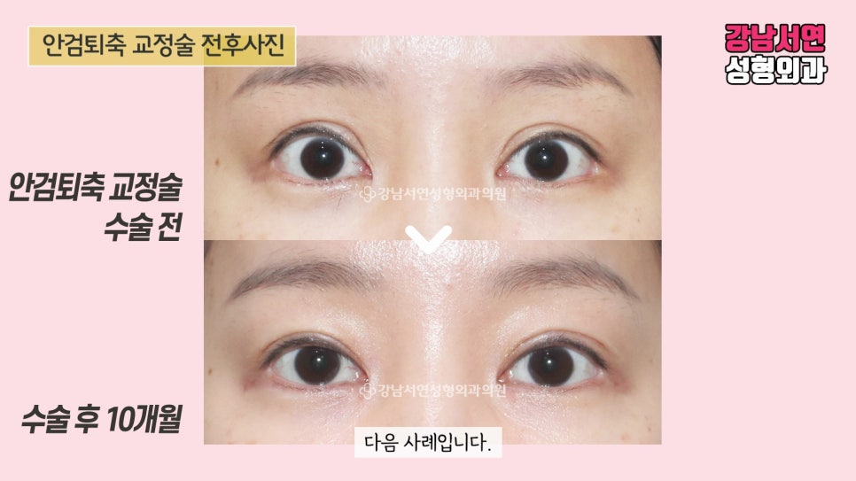 퇴축수술 전후 비교 사진