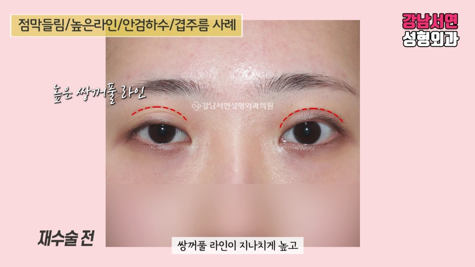 쌍꺼풀 재수술 전 사진