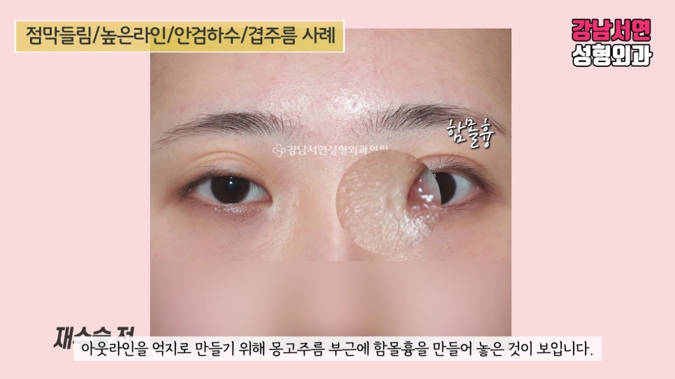 쌍꺼풀 재수술 전 사진