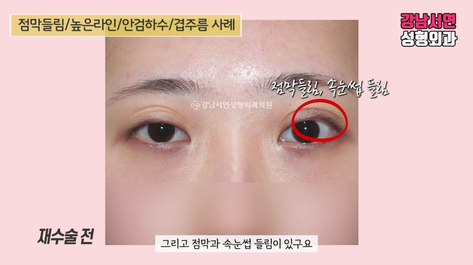 쌍꺼풀 재수술 전 사진