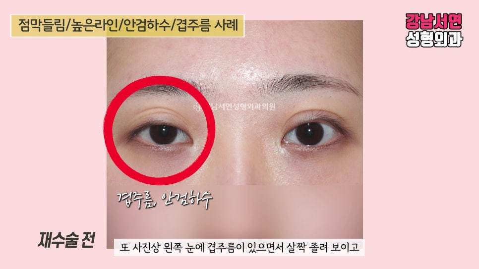 쌍꺼풀 재수술 전 사진