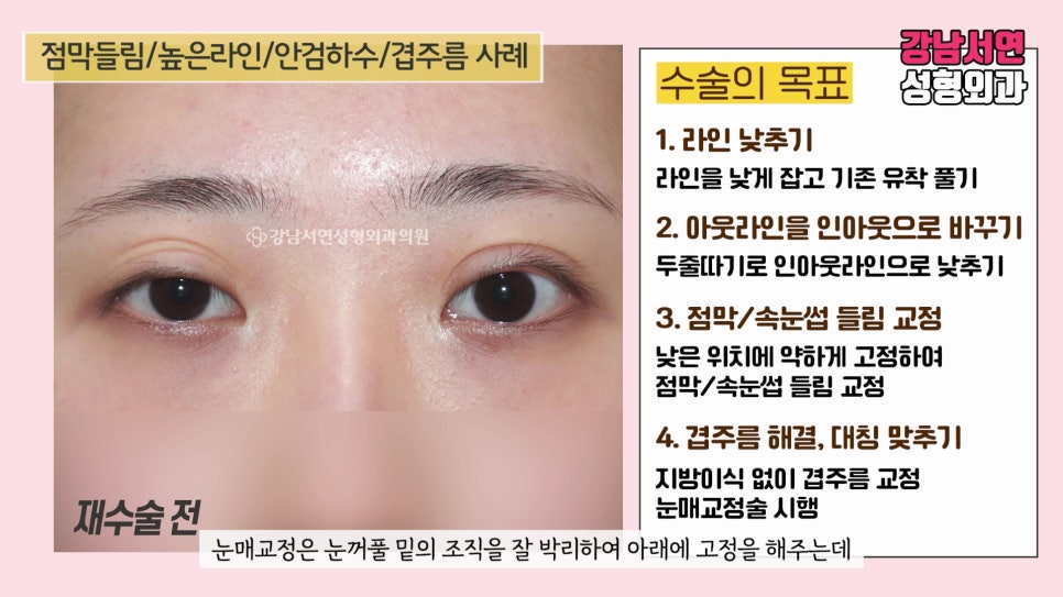 쌍꺼풀 재수술 설명 도해