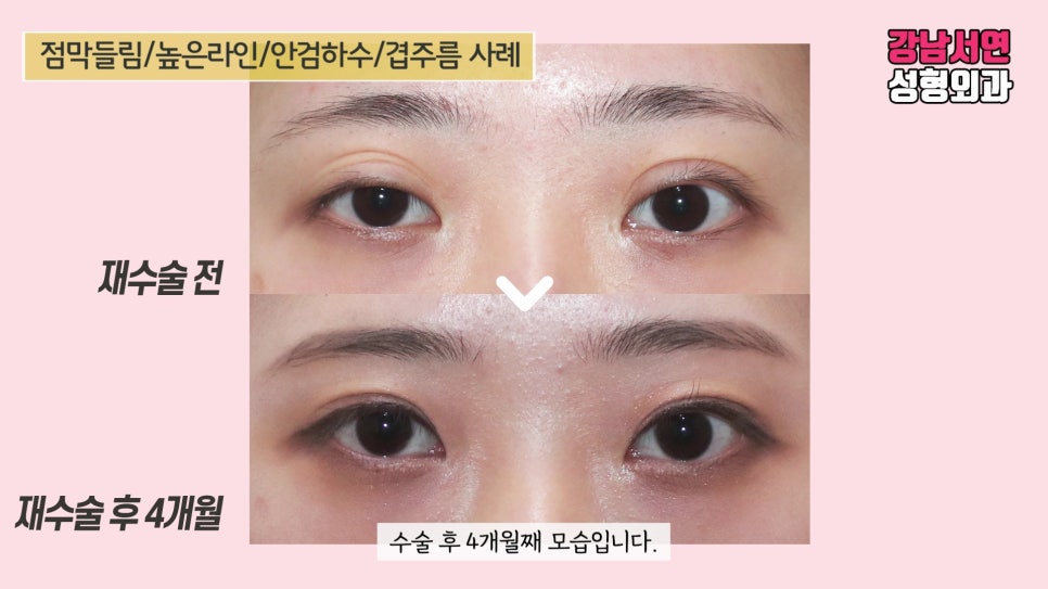 쌍꺼풀 재수술 전후 비교 사진
