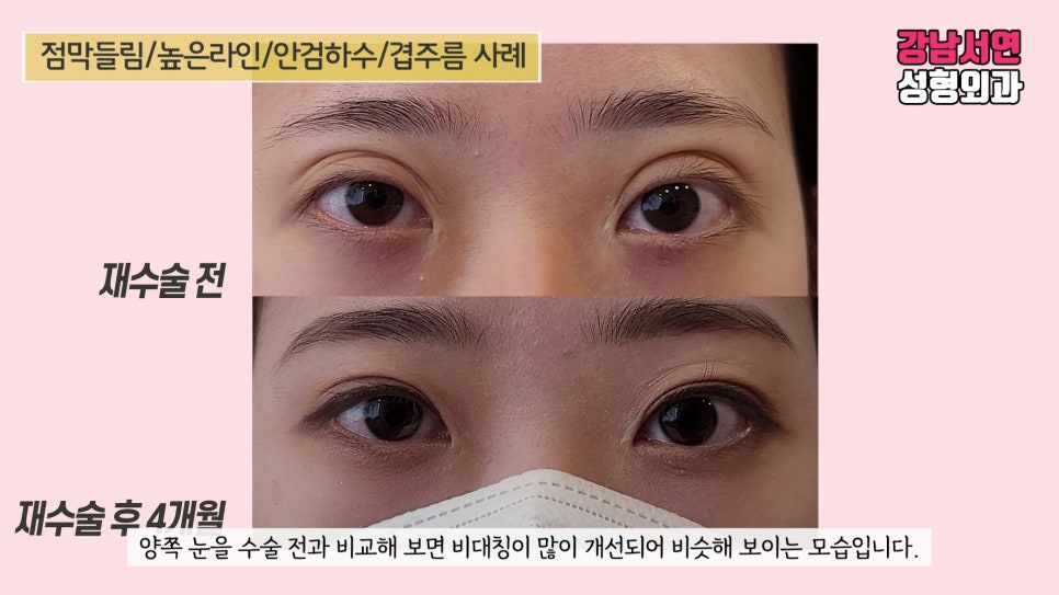 쌍꺼풀 재수술 전후 비교 사진