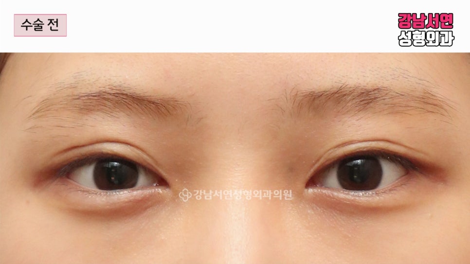 쌍꺼풀 재수술 전 사진
