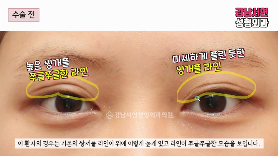 쌍꺼풀 재수술 전 사진