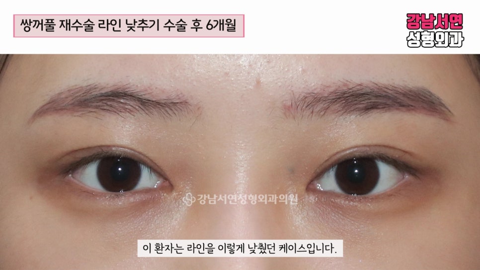 쌍꺼풀 재수술 후 사진