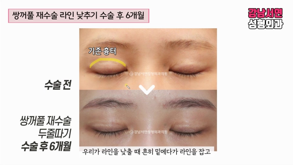 쌍꺼풀 재수술 전후 비교 사진
