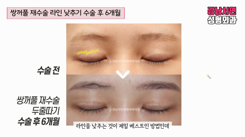 쌍꺼풀 재수술 전후 비교 사진