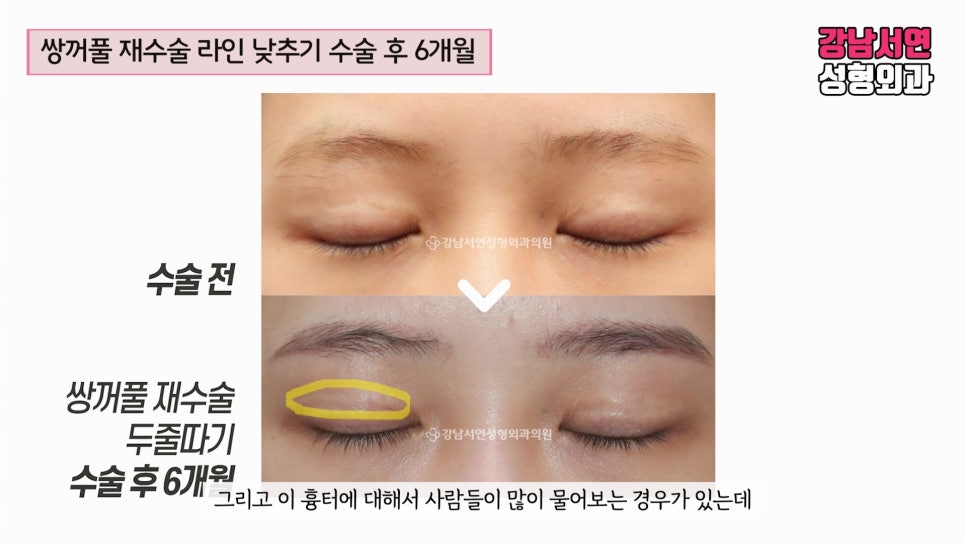 쌍꺼풀 재수술 전후 비교 사진