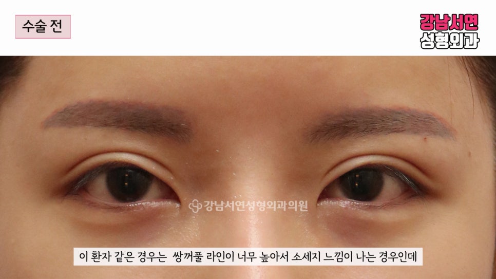 쌍꺼풀 재수술 전 사진