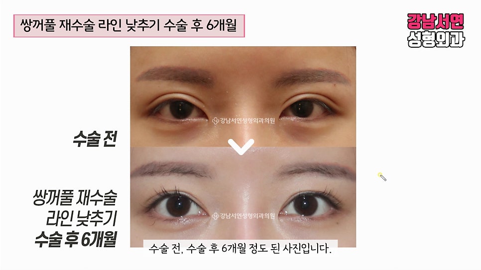 쌍꺼풀 재수술 전후 비교 사진