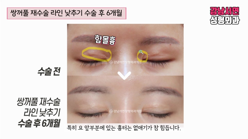 쌍꺼풀 재수술 전후 비교 사진