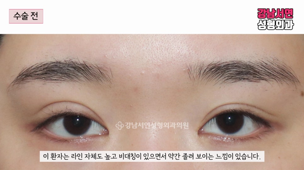 쌍꺼풀 재수술 전 사진