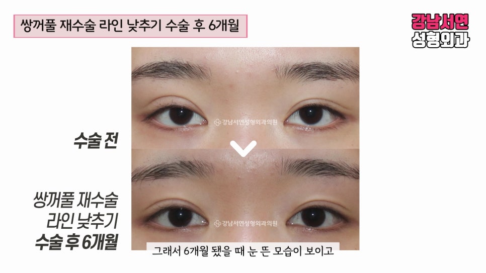 쌍꺼풀 재수술 전후 비교 사진